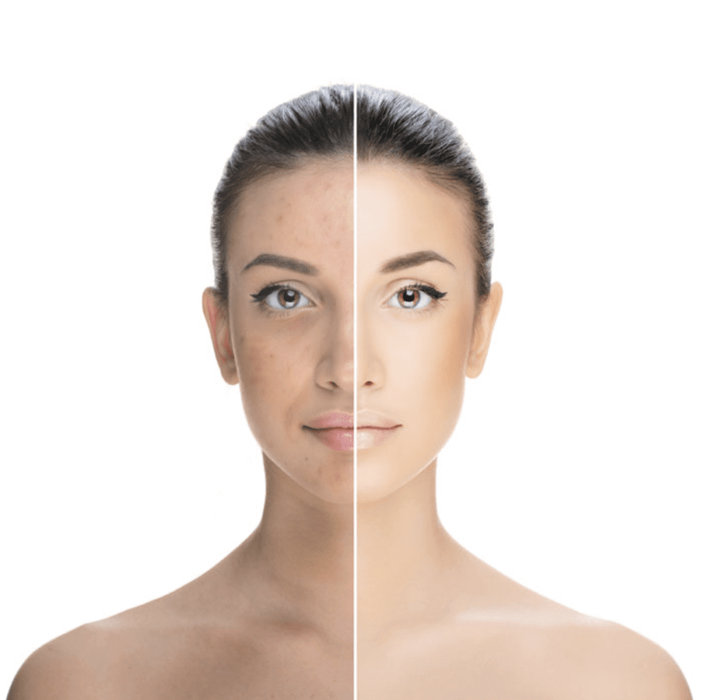 Impact of Hyperpigmentation Treatment on Quality of Life